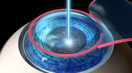 Laser Vision Correction Wallpaper High Definition