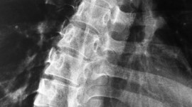 Scoliosis Wallpaper For IPhone Download