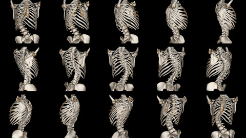 Scoliosis wallpapers high quality