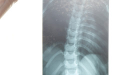 Scoliosis Wallpaper Gallery