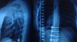 Scoliosis Wallpaper High Definition