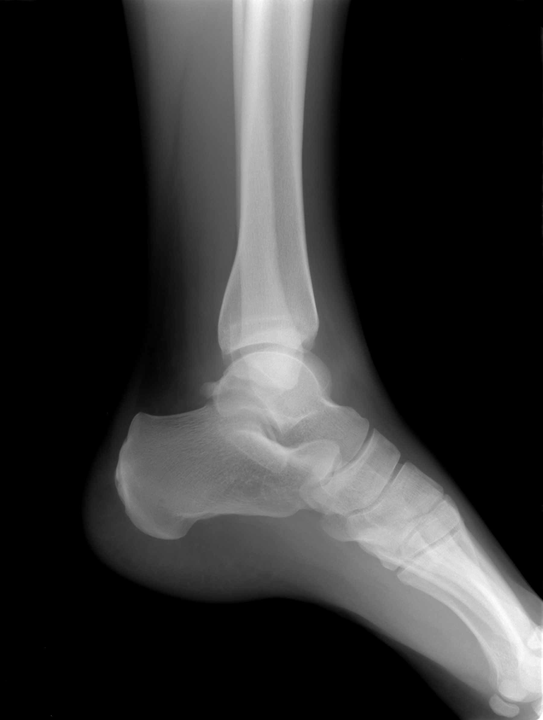 Голеностопный сустав левой ноги. Перелом лодыжки рентген. Рентген голеностопа остеопороз.