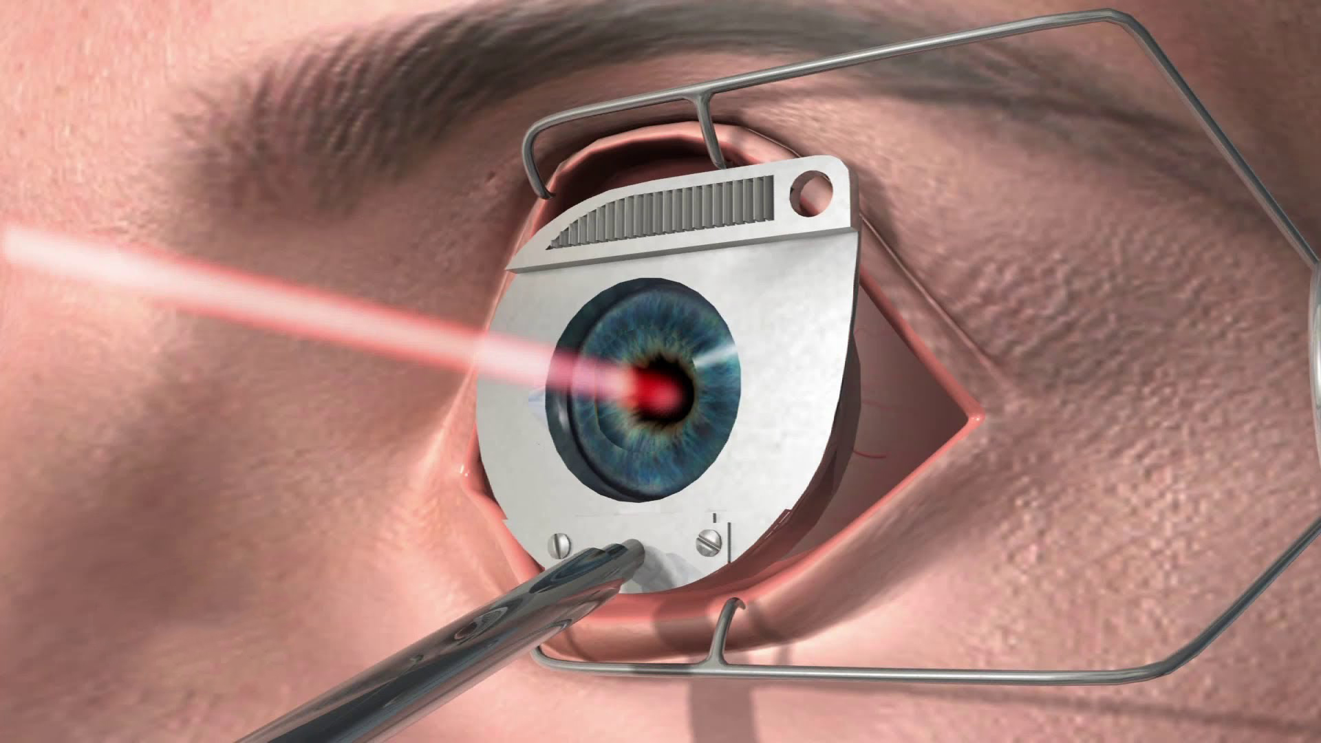 Вызвать глаз. LASIK лазерный кератомилез. Офтальмология Фемто ласик. Лазерная рефракционная кератопластика.